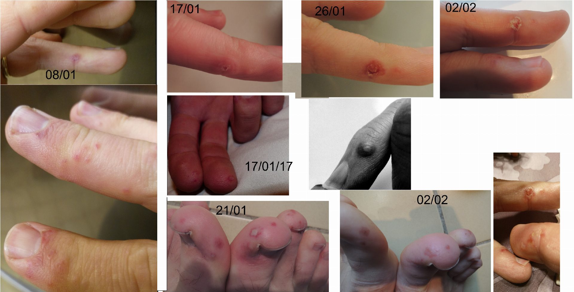 Spondylarthropathie et points rouges sur les doigts (vascularité ...