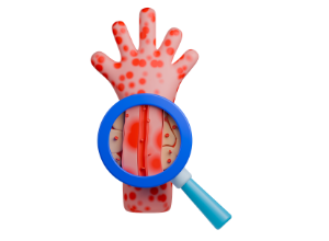 Purpura thrombopénique immunitaire (PTI) : comment se pose le diagnostic ?