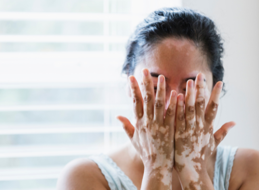 Vitiligo : pourquoi la peau perd-elle sa pigmentation ?