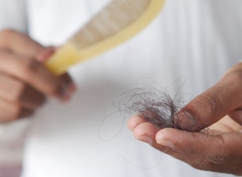  Perte de cheveux (alopécie) : tout ce qu'il faut savoir ! 