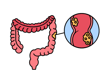 Cancer colorectal métastatique : que signifie ce diagnostic ?