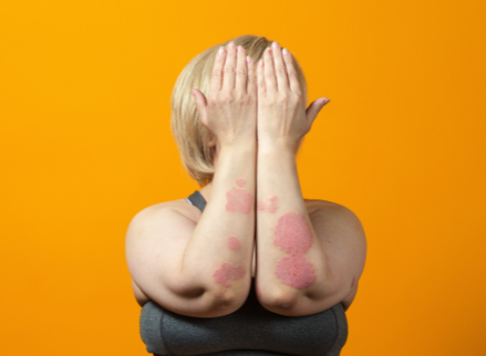 Psoriasis et estime de soi : comment se sentir mieux dans sa peau ?