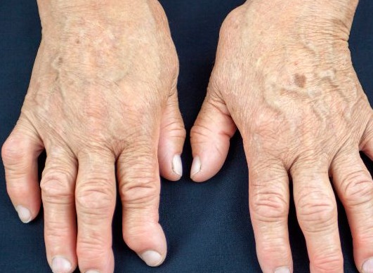 Pourquoi la polyarthrite rhumatoïde fatigue-t-elle autant le corps ? 