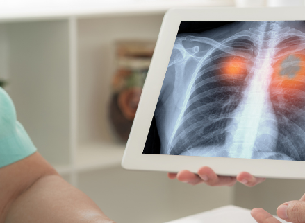 Cancer du poumon : quand une chirurgie est-elle possible ? 