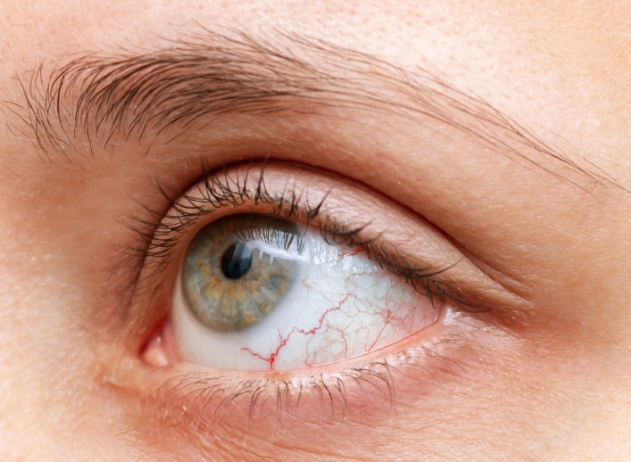 Les maladies inflammatoires chroniques de l'intestin (MICI) et les troubles oculaires, quel lien ?