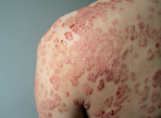 Psoriasis : décrypter les poussées pour mieux vivre avec la maladie