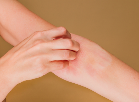 Dermatite atopique : comprendre pourquoi la nuit devient un vrai défi