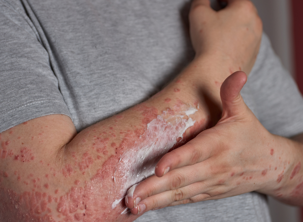 « Mon psoriasis n’a jamais réussi à obtenir son visa pour entrer dans ma tête » : le témoignage de Phildu