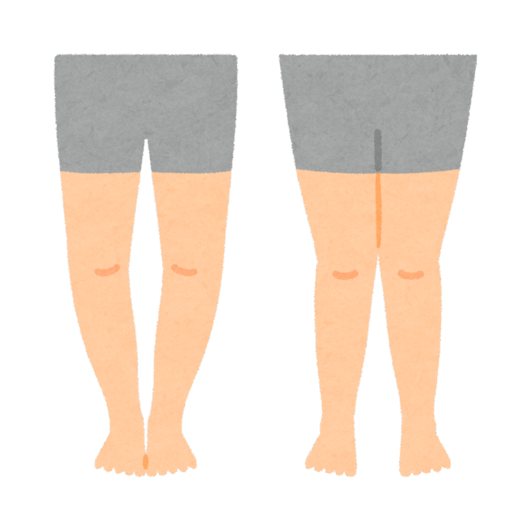 Jambes en “O” à gauche et jambes en “X” à droite