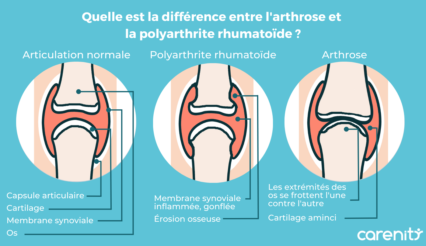 Qu'est-ce que l'arthrose ?